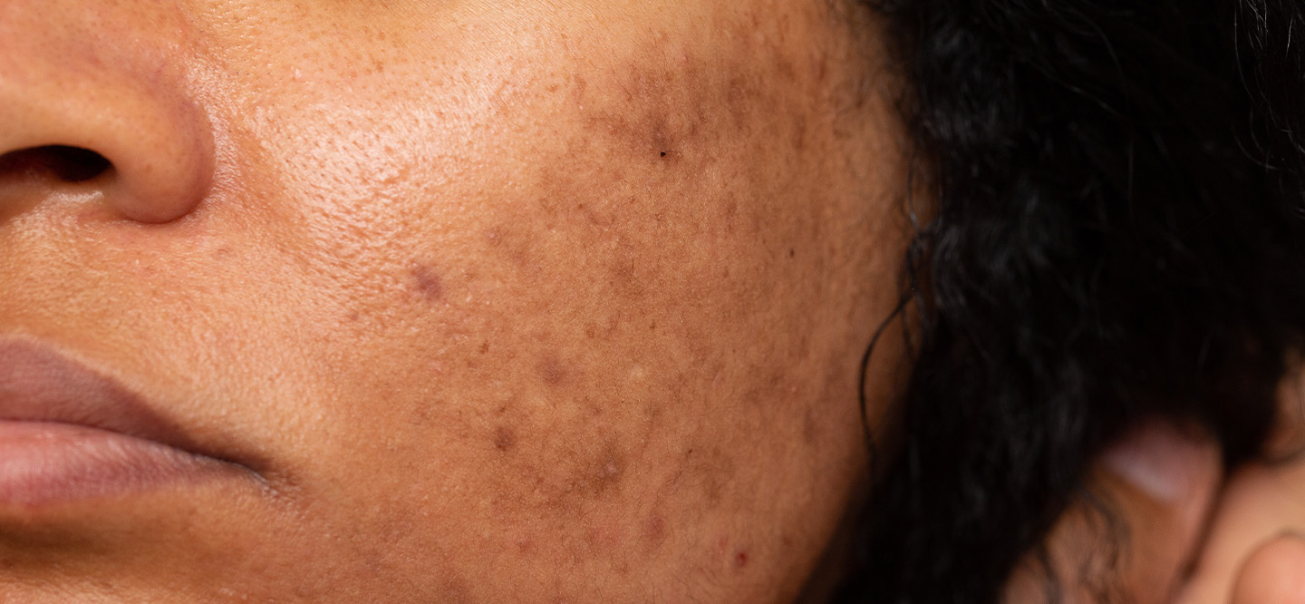 Acne Scarring Treatment Portsmouth, NH| Near Me