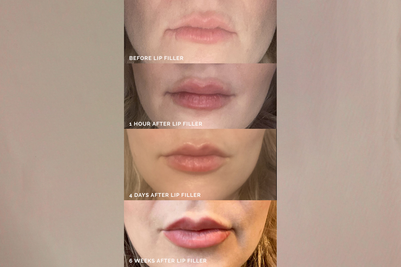 My-lip-filler-journey
