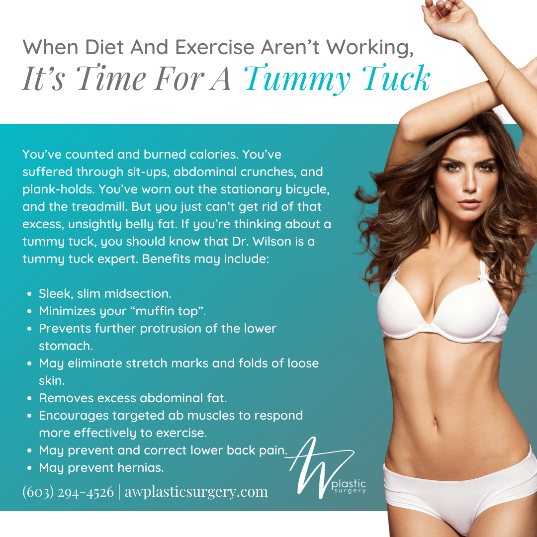 When Diet and Exercise Aren’t Working, It’s Time for a Tummy Tuck