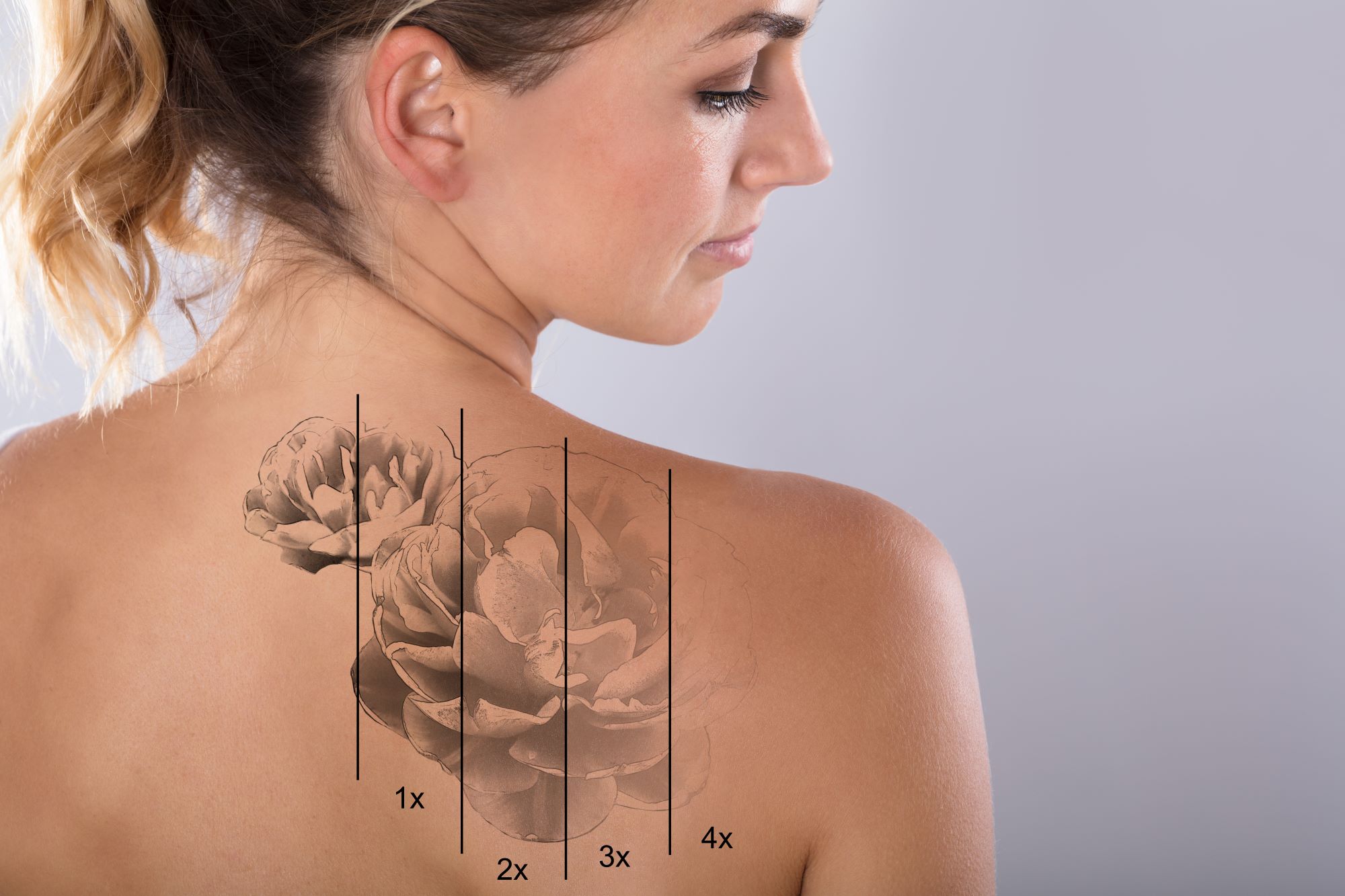 Erase the Past with Confidence: Comparing Tattoo Removal Options and the Power of PicoWay® Laser
