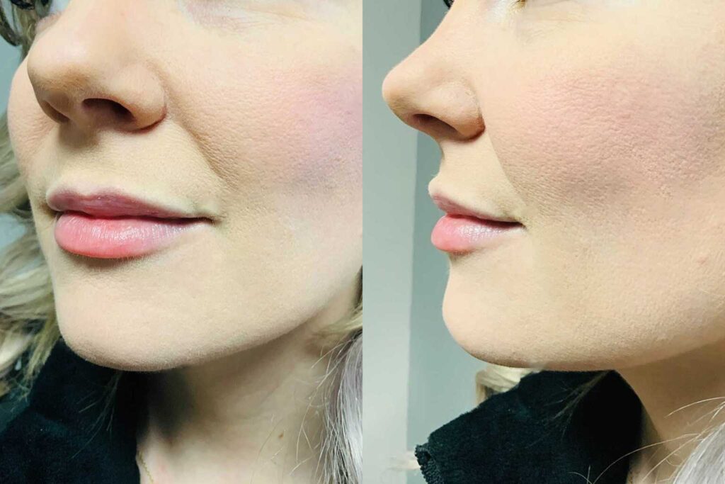 my-lips-two-weeks-after-injections_new